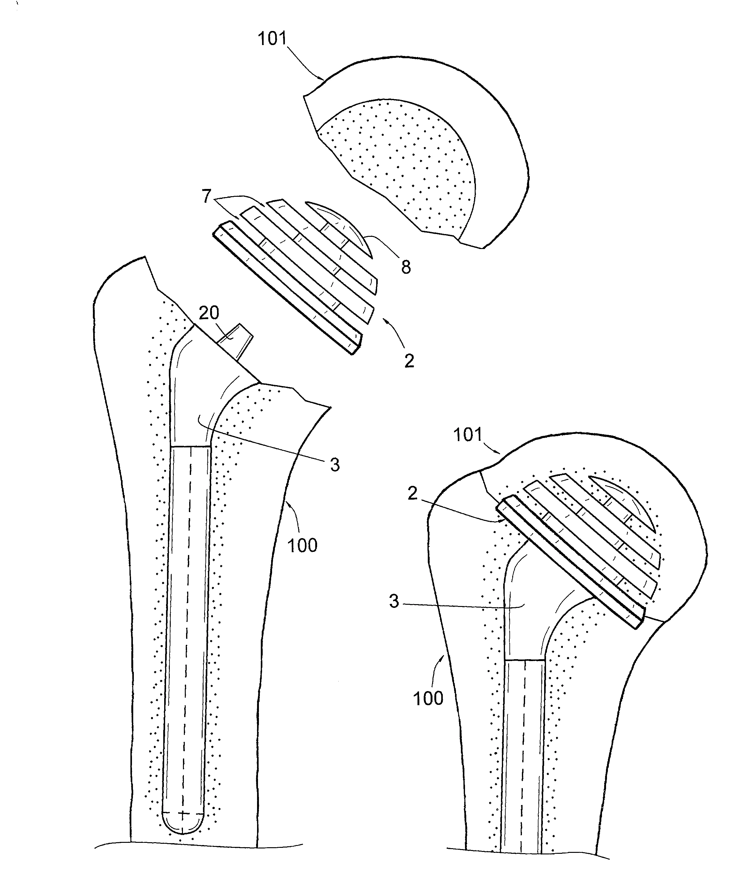 Materiel d'osteosynthese permettant la remise en place d'une tete osseuse articulaire sur l'os correspondant