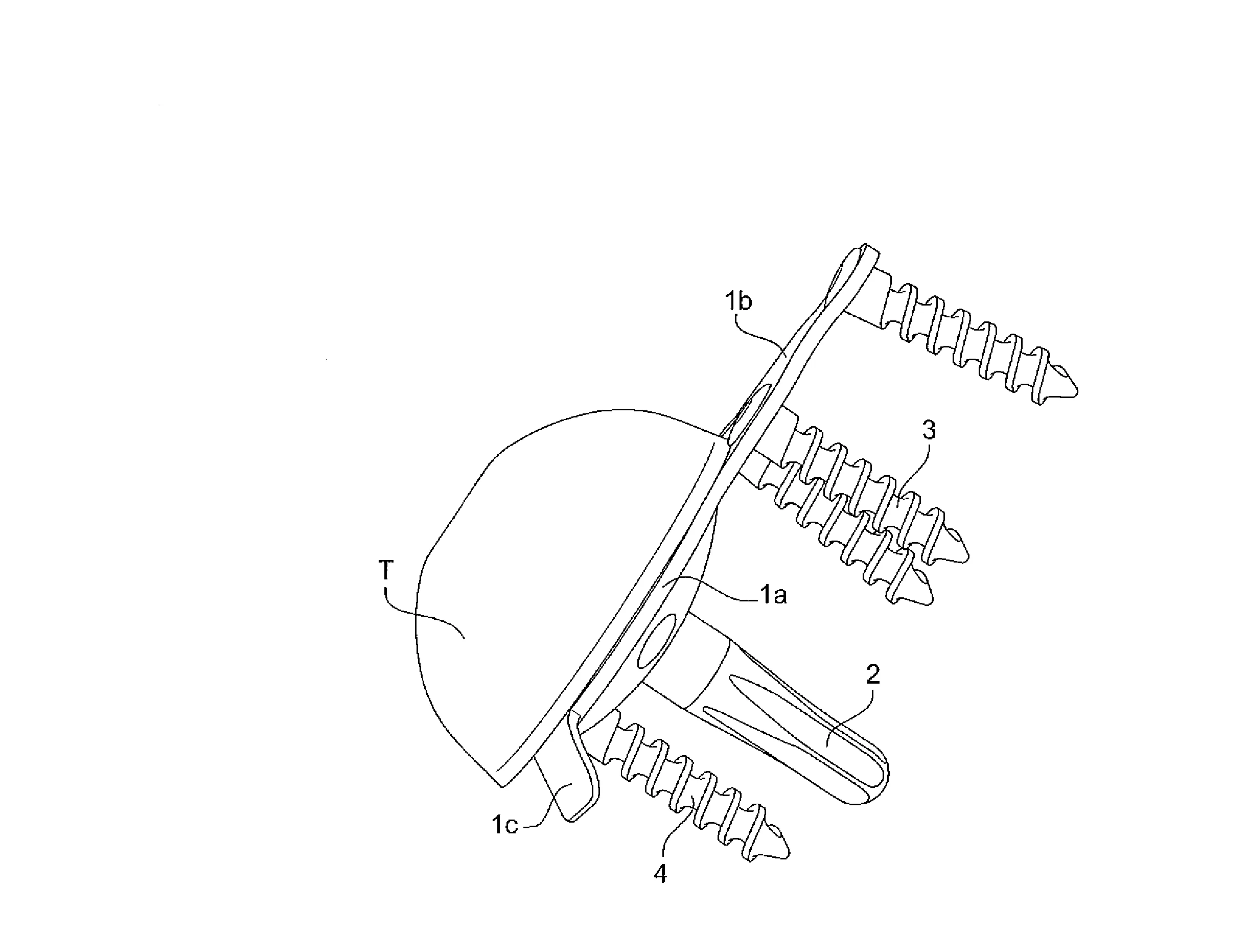 Ensemble glenoidien pour prothese d'epaule