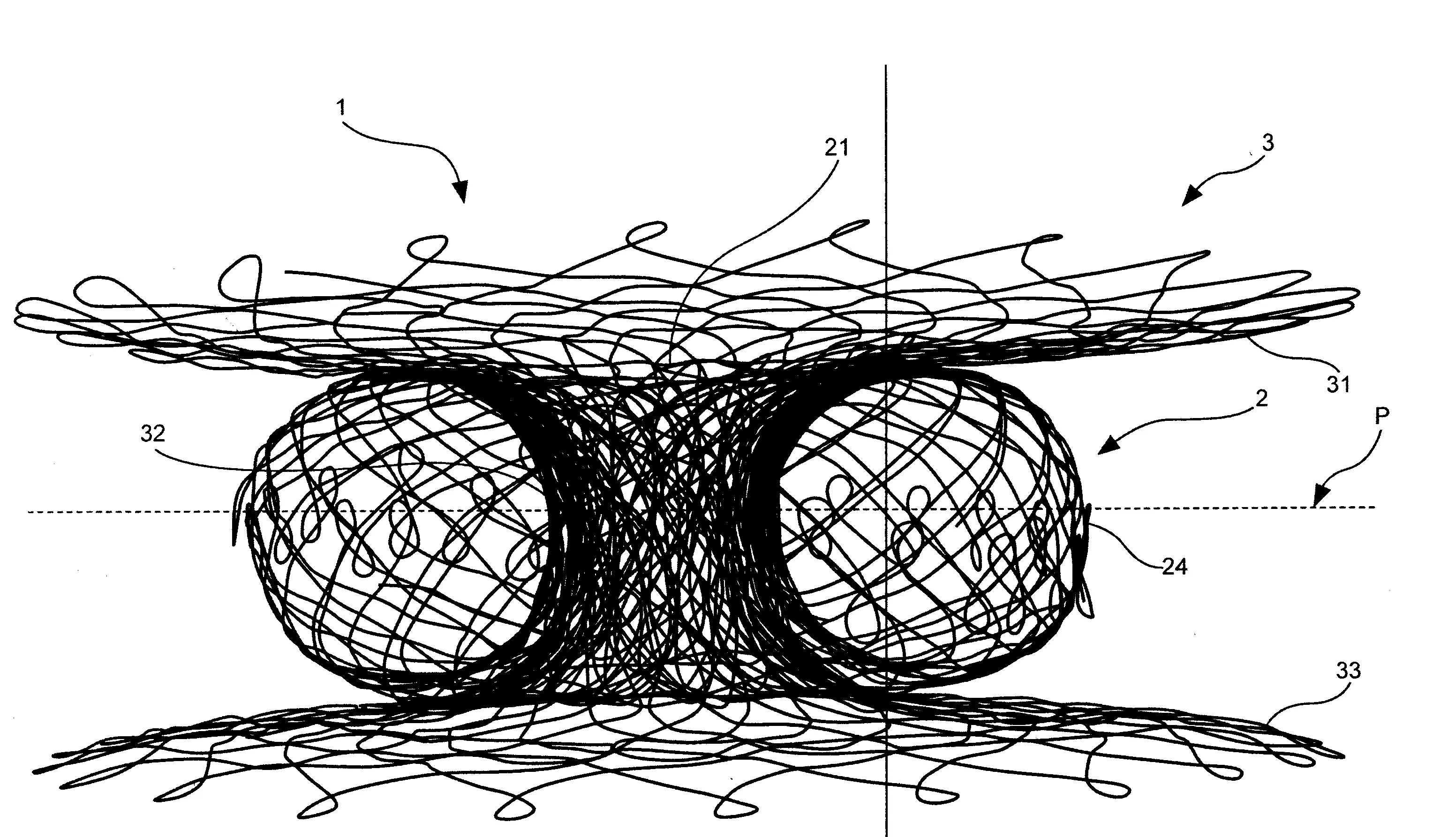 Dispositif d'ancrage d'une valve cardiaque prothetique.
