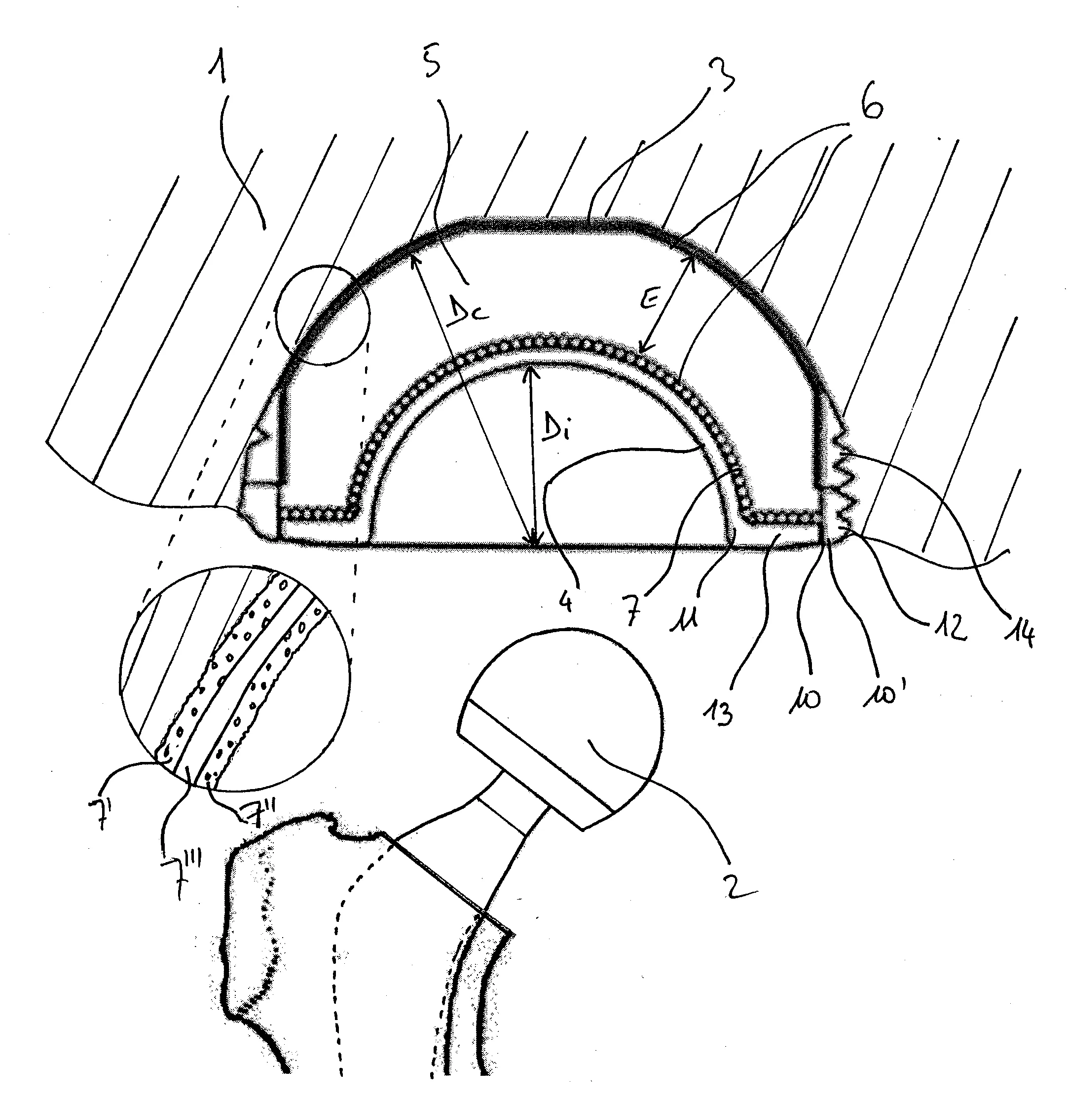 Implant articulaire de hanche a structure ternaire.