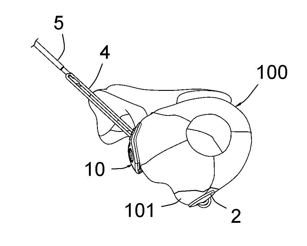 Materiel d'osteosynthese permettant de repositionner un fragment d'os sur la partie de base de cet os