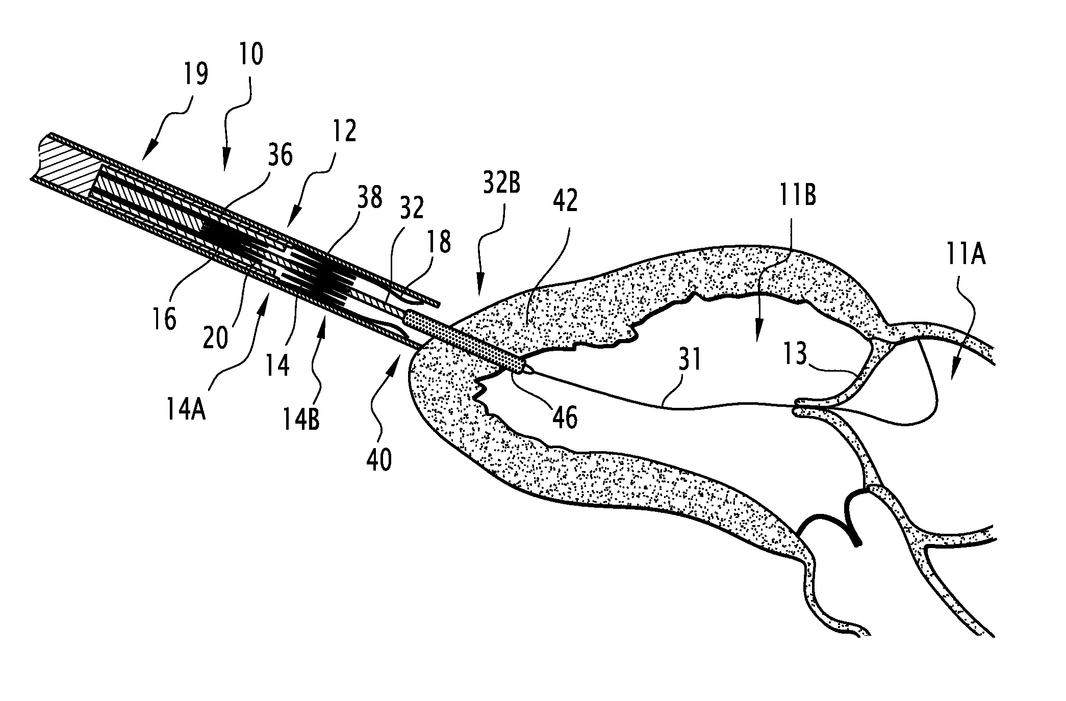 Dispositif atraumatique d'introduction d'un element tubulaire creux dans un organe biologique