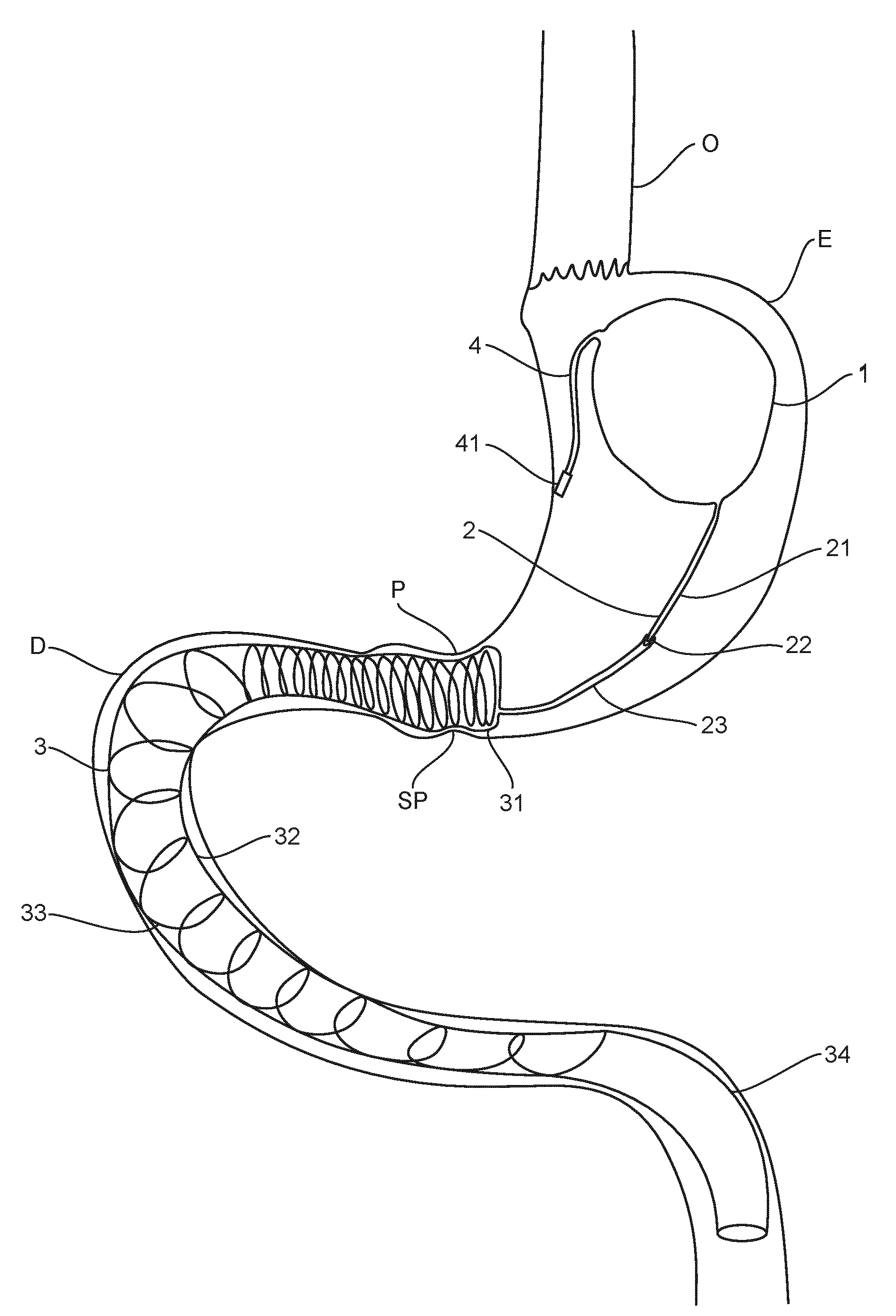 Dispositif prothetique implantable pour la perte de poids d'un patient obese ou en surpoids comprenant un ballon gastrique gonflable et une prothese duodenale