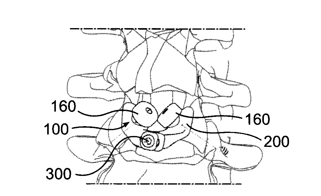 Implant vertebral, procede de mise en place d'un tel implant et outil pour la mise en place de l'implant