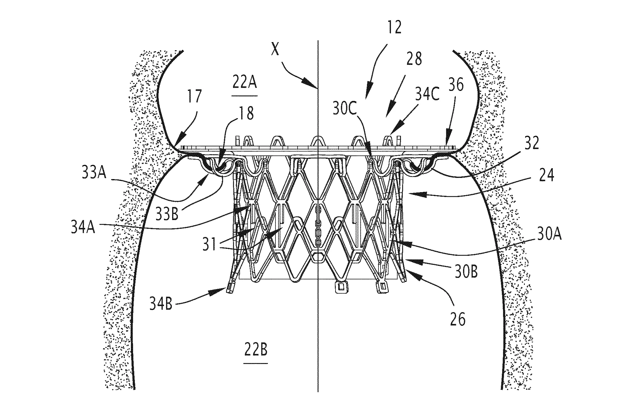 Implant de traitement d'une valve biologique